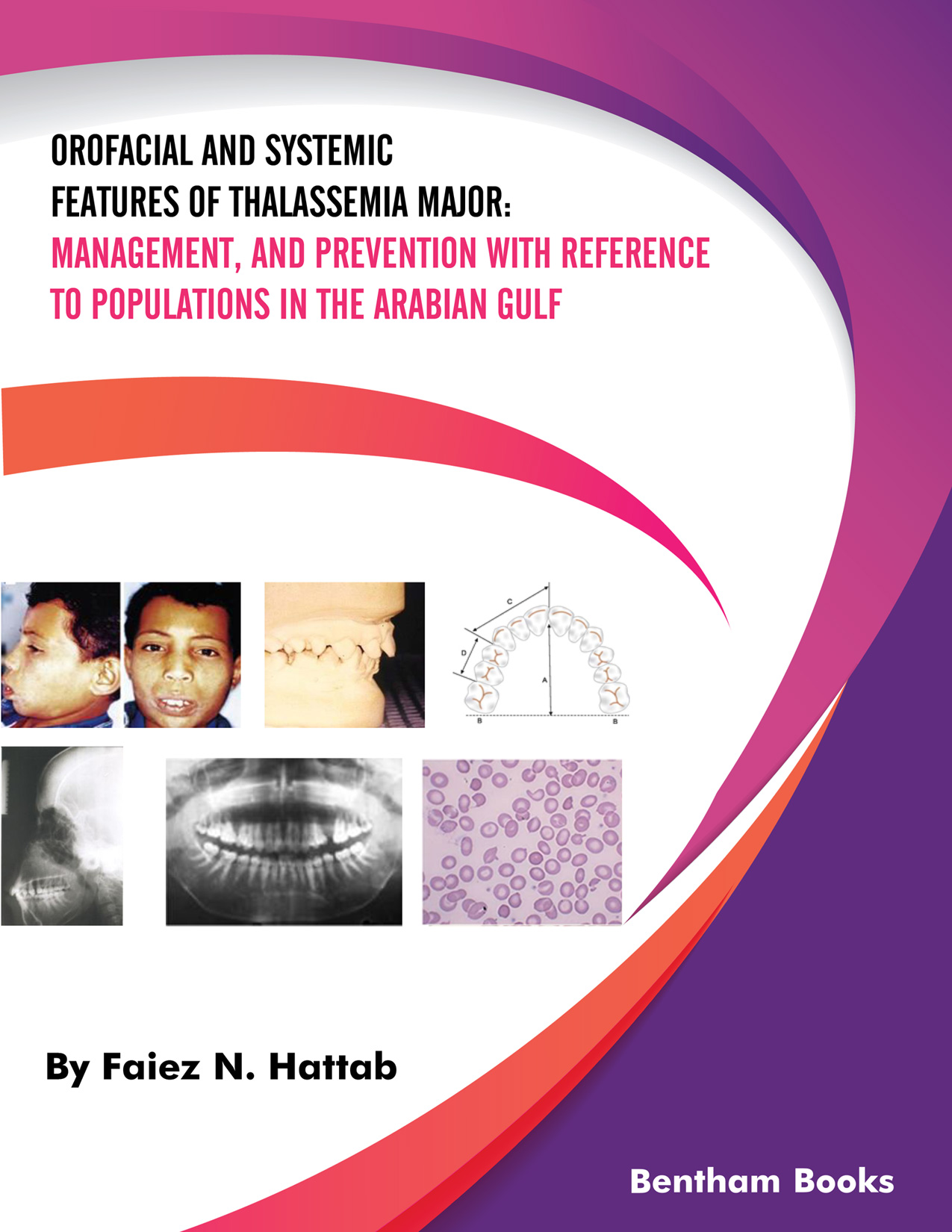 Orofacial and Systemic Features of Thalassemia Major: Management, and Prevention with Reference to Populations in the Arabian Gulf