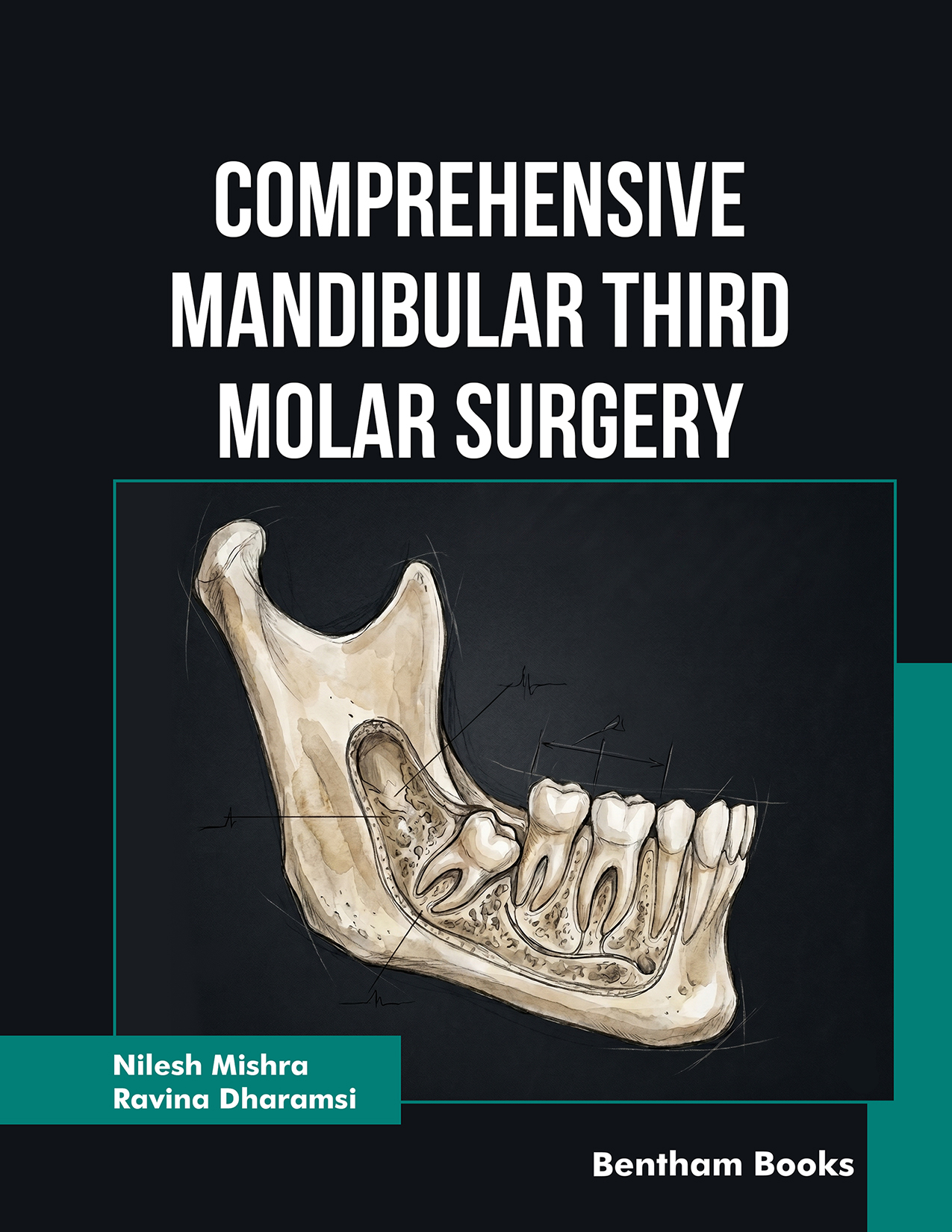 Comprehensive Mandibular Third Molar Surgery Comprehensive Mandibular Third Molar Surgery