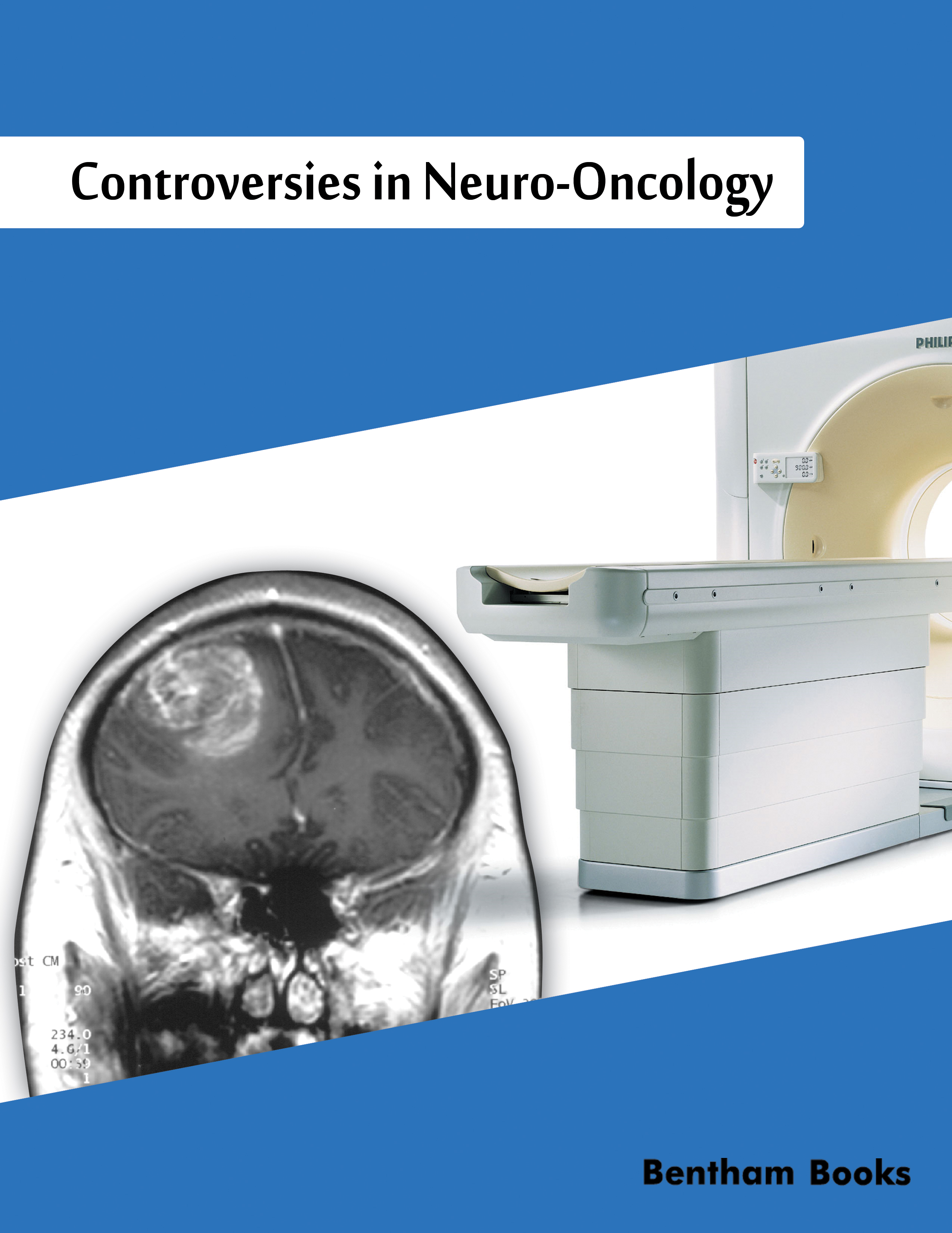 Controversies in Neuro-Oncology Controversies in Neuro-Oncology